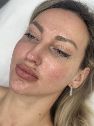 После процедуры