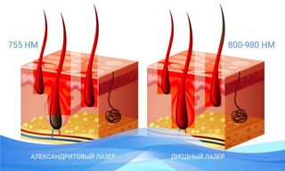 ЛАЗЕРНАЯ ЭПИЛЯЦИЯ. Современный метод избавления от нежелательных волос