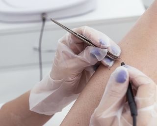 ЛАЗЕРНАЯ ЭПИЛЯЦИЯ. Современный метод избавления от нежелательных волос